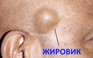 Удалить жировик на лице в домашних условиях