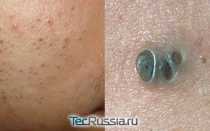 Виды прыщей