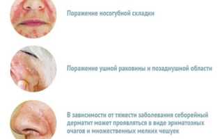 Сухой себорейный дерматит на лице лечение