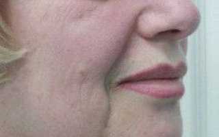 Филлеры какие лучше