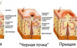 Как убрать угри с носа