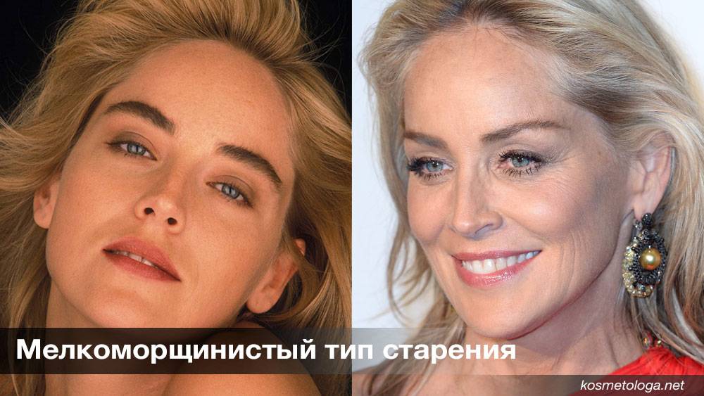 Старение лица
