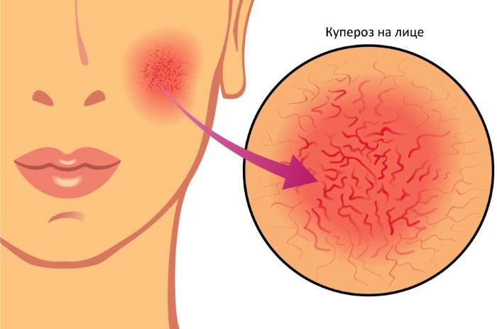 Лечение купероза на лице