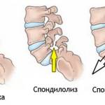 Смещенные позвонки болит спина