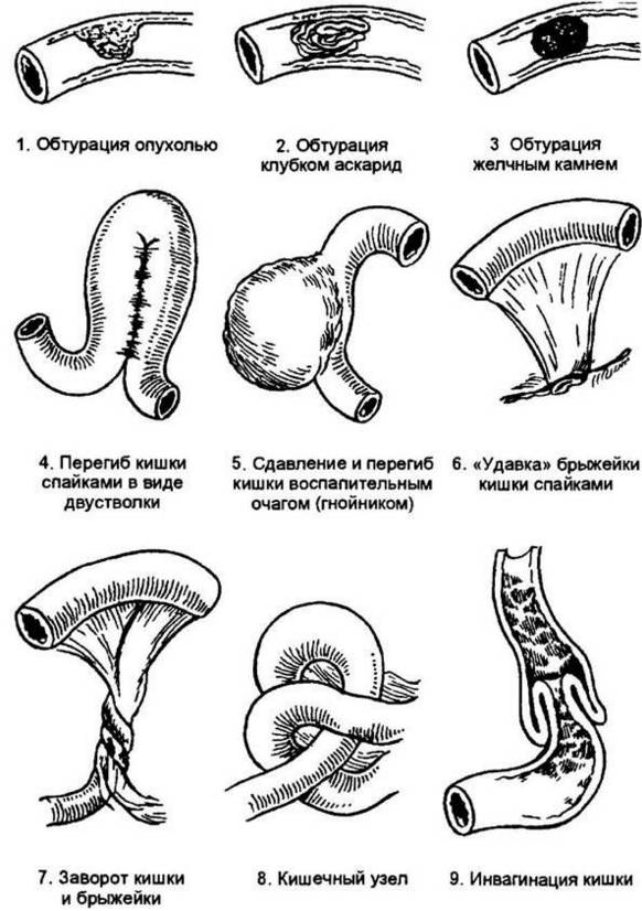 Kishechnaya neprokhodimost' - vozmozhnyye prichiny. Кишечная непроходимость - возможные причины.