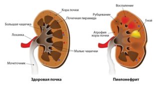 От чего болит в левом подреберье и отдает в спину
