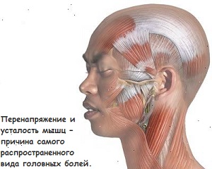 Головная боль напряжения