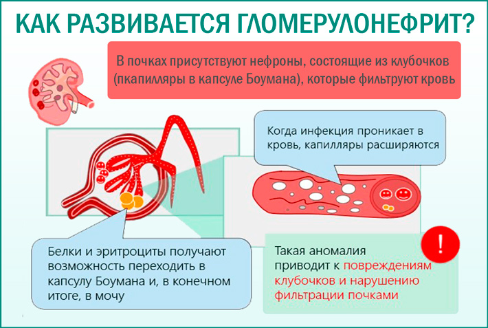 Как развивается гломерулонефрит? Гломерулонефрит: симптомы