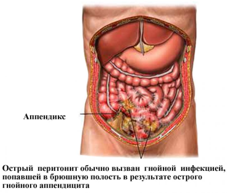 Острый перитонит