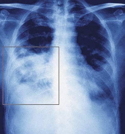 Свиной грипп А(H1N1)